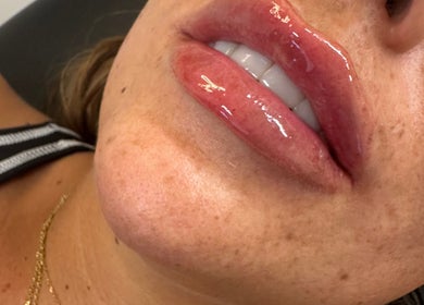 Close-up of shiny lips treated at You Glow Girl Aesthetics and Beauty Maidstone Kent, Maidstone, England, GB.