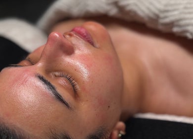 Facial treatment at Simply Radiant Skin and Body Clinic, Melbourne, Victoria, AU, revealing glowing skin.