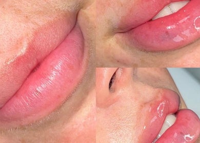 Close-up of glossy lip enhancement at Absolute Aesthetics, Dyce, Scotland, GB.