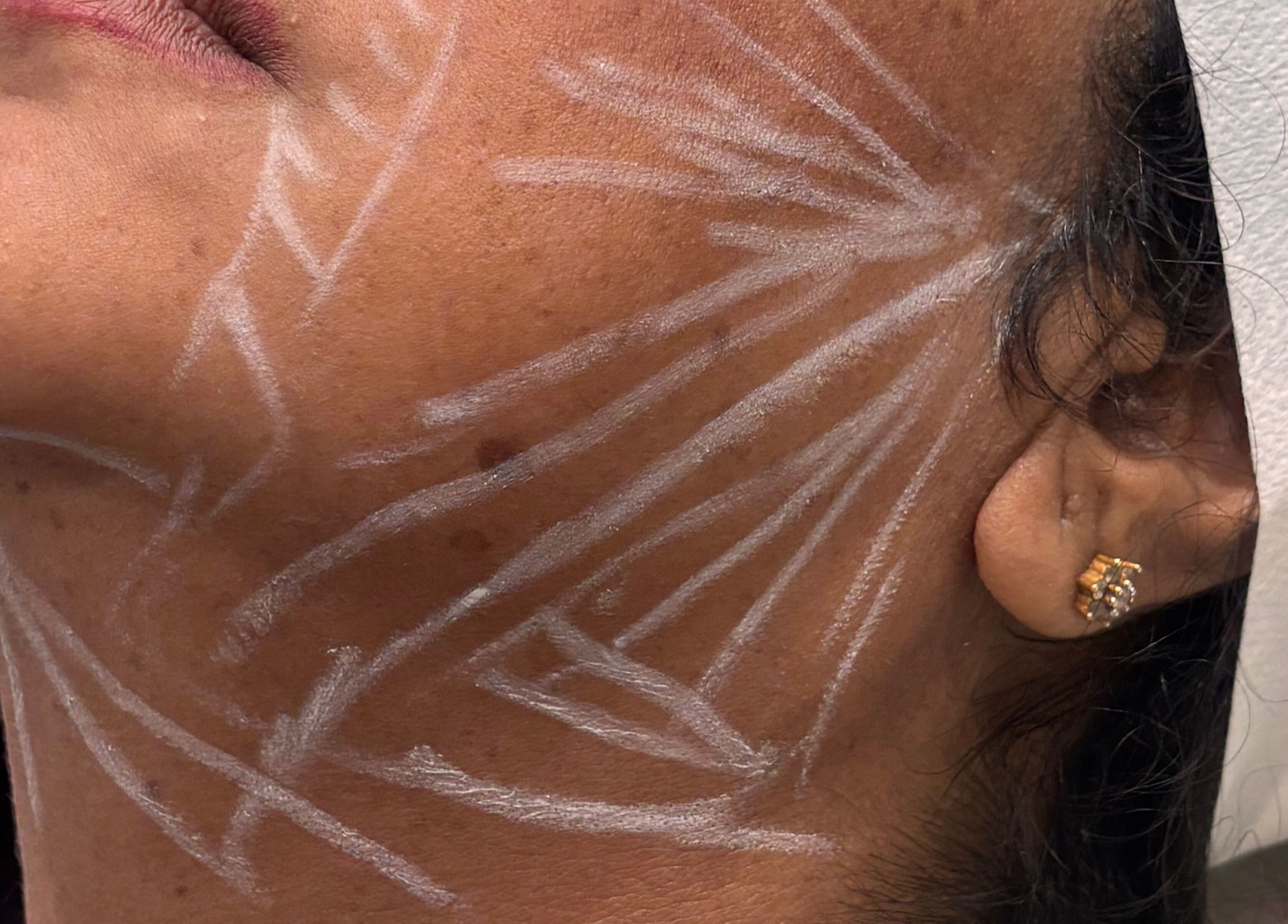 Ml Aesthetics facial contouring lines in Birmingham, England, GB showcasing treatment preparation.