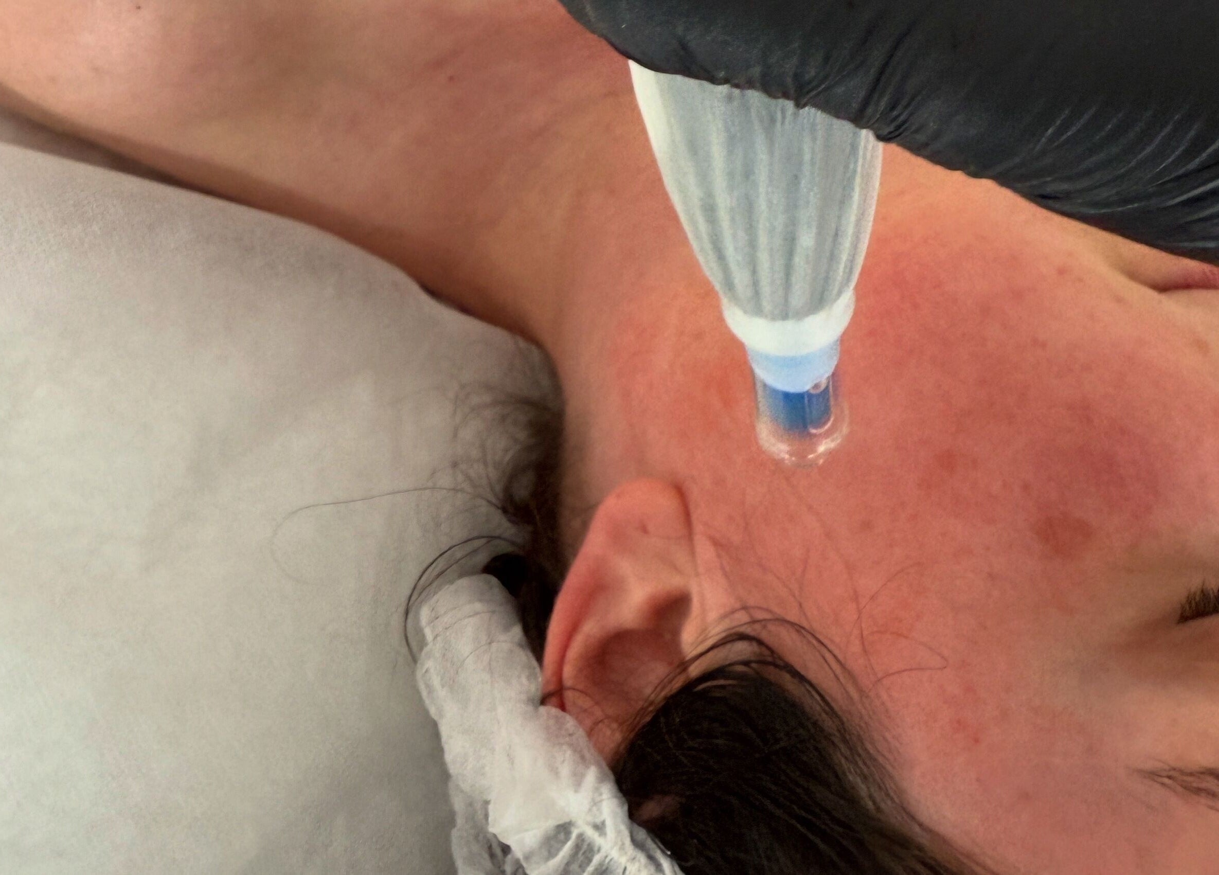 Hydrafacial treatment at Skin & Brow Collective, Peregian Springs, Queensland, AU, enhancing skin radiance.
