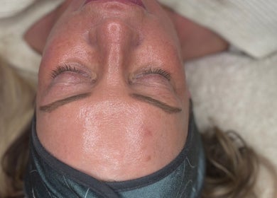 Facial treatment at Natalie Mcintyre Aesthetics, Bishopbriggs, Scotland, GB, showcasing smooth and radiant skin.