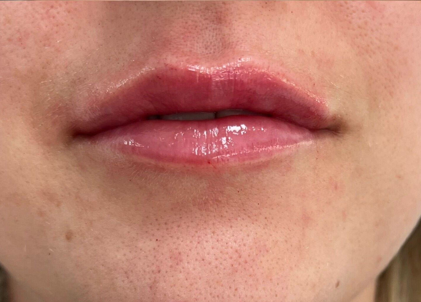 Glossy lips shown after enhancement at Natalie Mcintyre Aesthetics, Bishopbriggs, Scotland, GB.