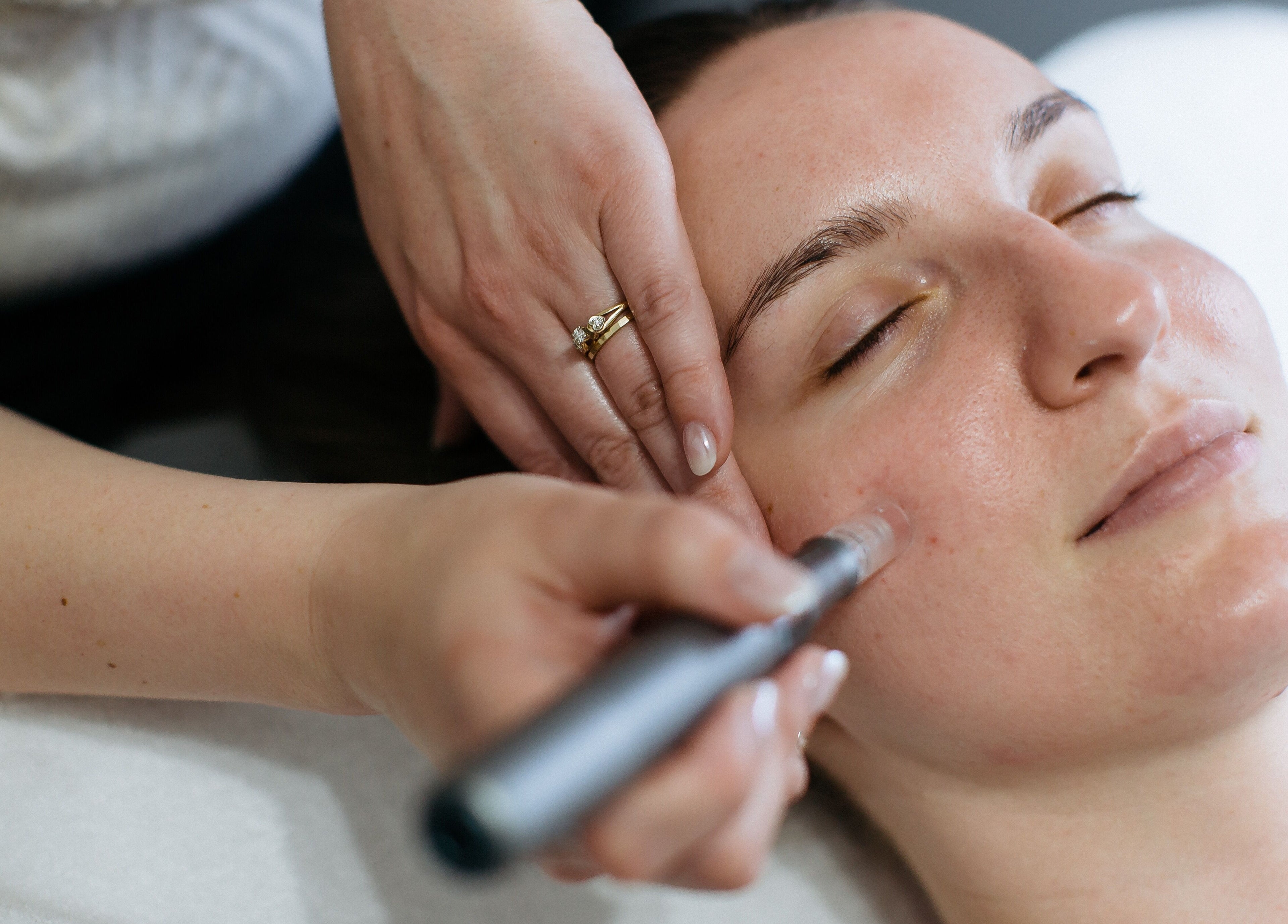 Microneedling facial at Sugar and Stone Aesthetics in Kingston, Ontario, CA enhances skin texture.