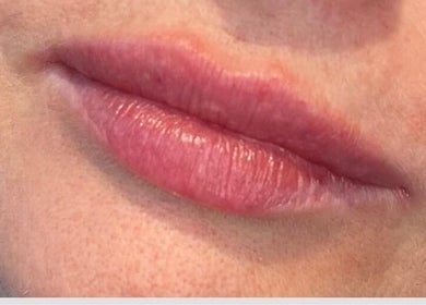 Close-up of lips showcasing treatment at Advanced Aesthetics Clinic Ltd - Tiptree in Tiptree, England, GB.