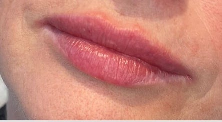Close-up of lips showcasing treatment at Advanced Aesthetics Clinic Ltd - Tiptree in Tiptree, England, GB.