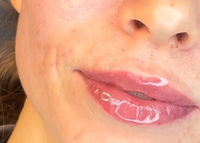 Close-up of glossy lips after treatment at Aesthetics by Hayley, London, England, GB enhancing natural beauty.