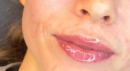 Close-up of glossy lips after treatment at Aesthetics by Hayley, London, England, GB enhancing natural beauty.