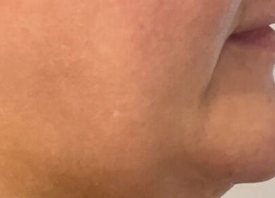 Smooth skin treatment at Aesthetics by Hayley, London, England, GB showcases youthful glow and vitality.