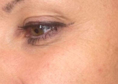 Close-up of a glowing eye with refined skin at Aesthetics by Hayley, London, England, GB.
