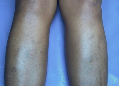 Relaxed legs on a purple mat at Aesthetic Haven, Saint James, Saint James, BB showcasing smooth skin.