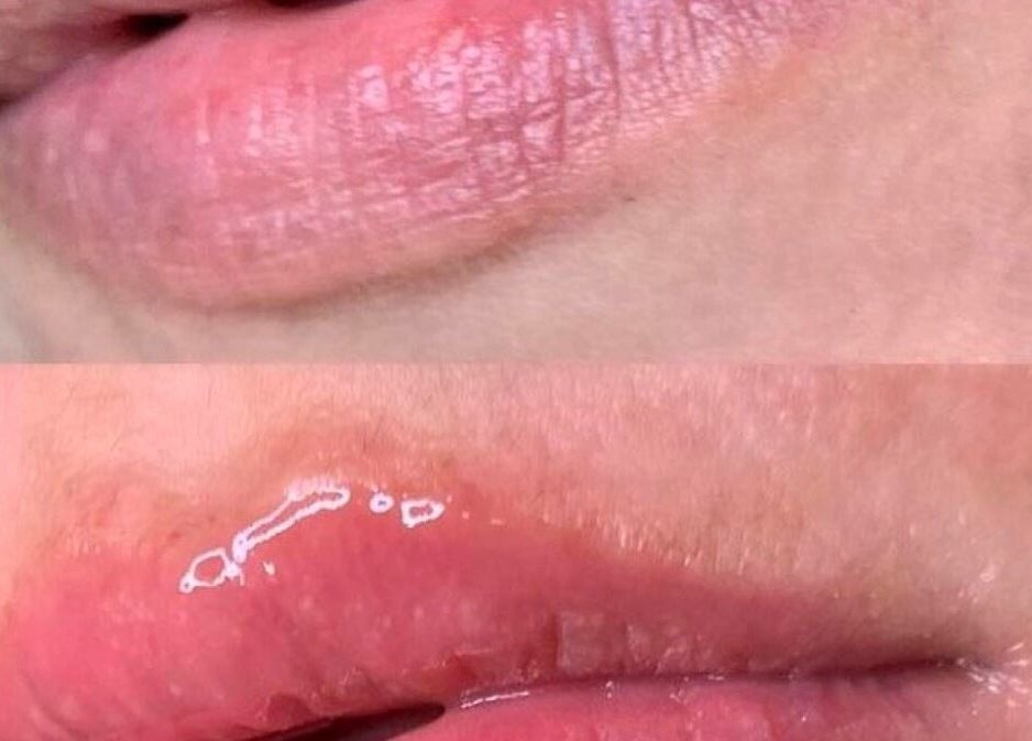 Transformación de labios en Laura Sandoval Studio, Tecate, Baja California, MX. Resultados visibles y cuidados.
