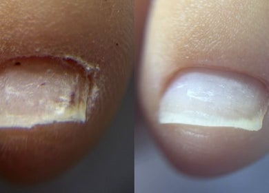 Before and after nail treatment at ProBeauty, Virginia Beach, Virginia, US. Healthy transformation.