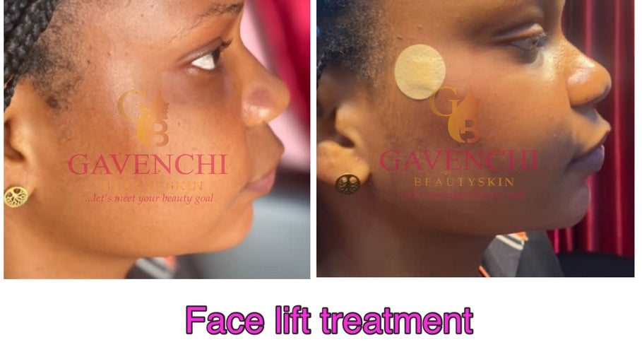 Before and after facelift results at Gavenchi BeautySkin, Lagos, Lagos, NG showcasing smooth skin transformation.
