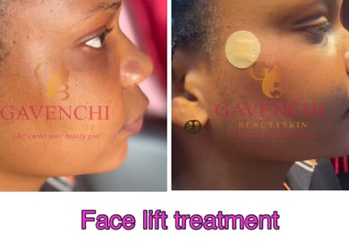Before and after facelift results at Gavenchi BeautySkin, Lagos, Lagos, NG showcasing smooth skin transformation.