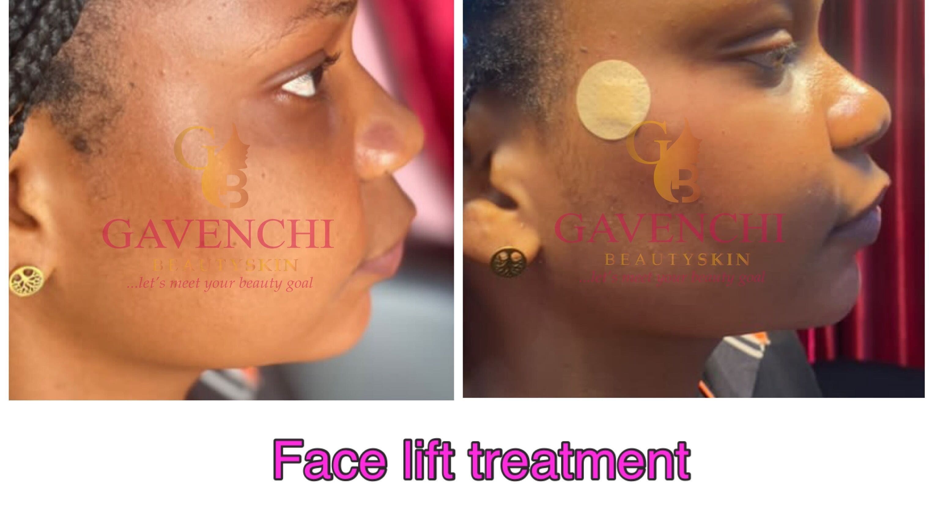 Before and after facelift results at Gavenchi BeautySkin, Lagos, Lagos, NG showcasing smooth skin transformation.