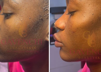 Before and after skin treatment at Gavenchi BeautySkin, Lagos, Lagos, NG.