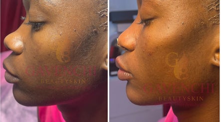 Before and after skin treatment at Gavenchi BeautySkin, Lagos, Lagos, NG.