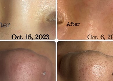 Before and after skin treatment at Amelia Beauty, Manchester, England, GB, highlighting smooth, clear skin results.