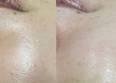 Before and after skin treatment at Amelia Beauty in Manchester, England, GB, showcasing smooth and radiant results.