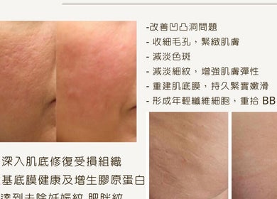Close-up of skin before and after treatment at Amelia Beauty in Manchester, England, GB.