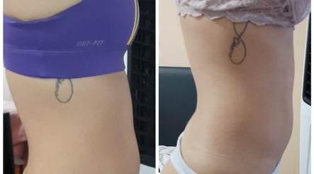 Antes y después de tratamiento corporal en Tozcana, Estetica y Relax, San Miguel De Tucumán, Tucumán, AR.