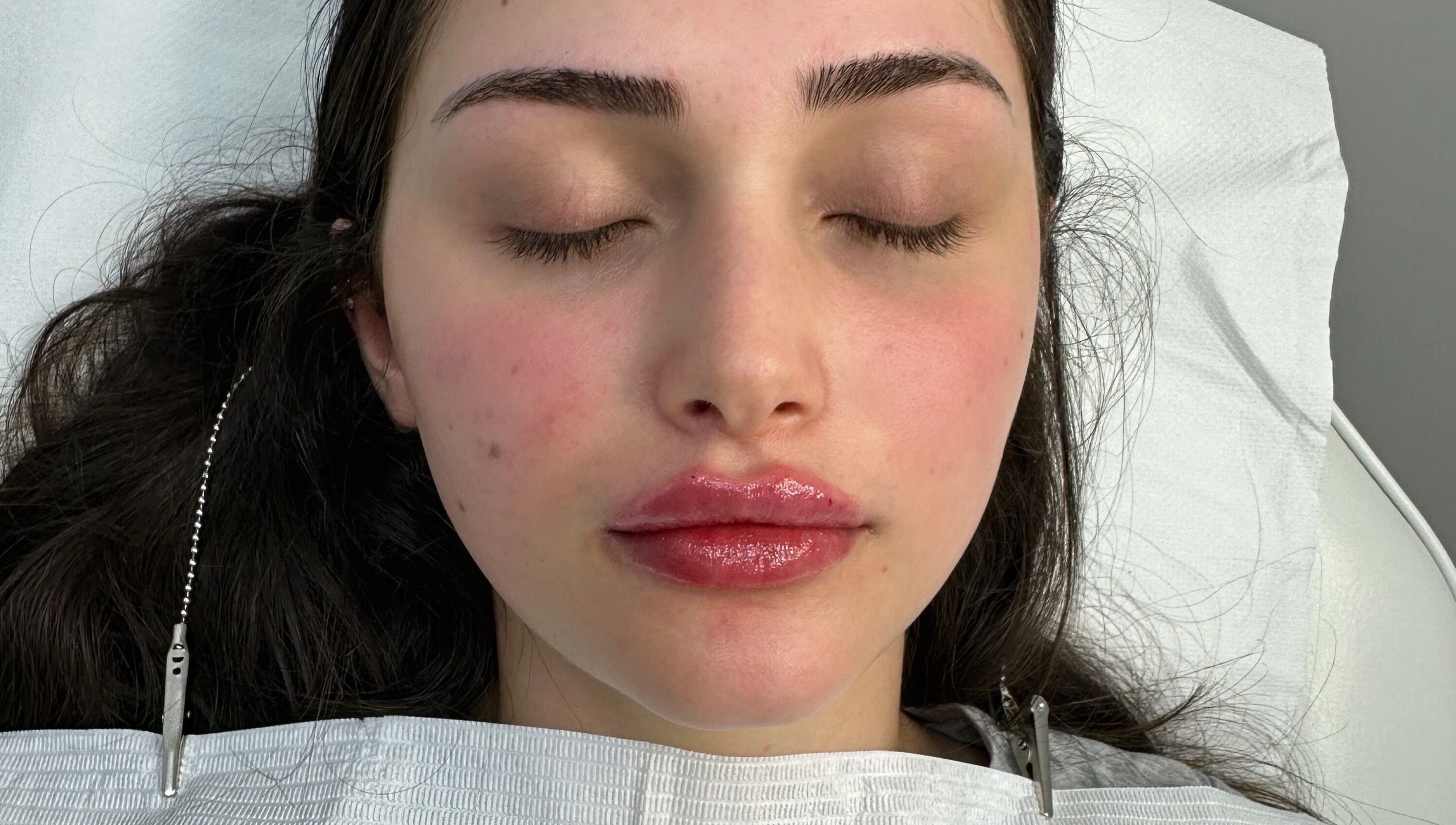 Relaxed client after lip treatment at Amavi Aesthetics, Kingston Upon Thames, England, GB.