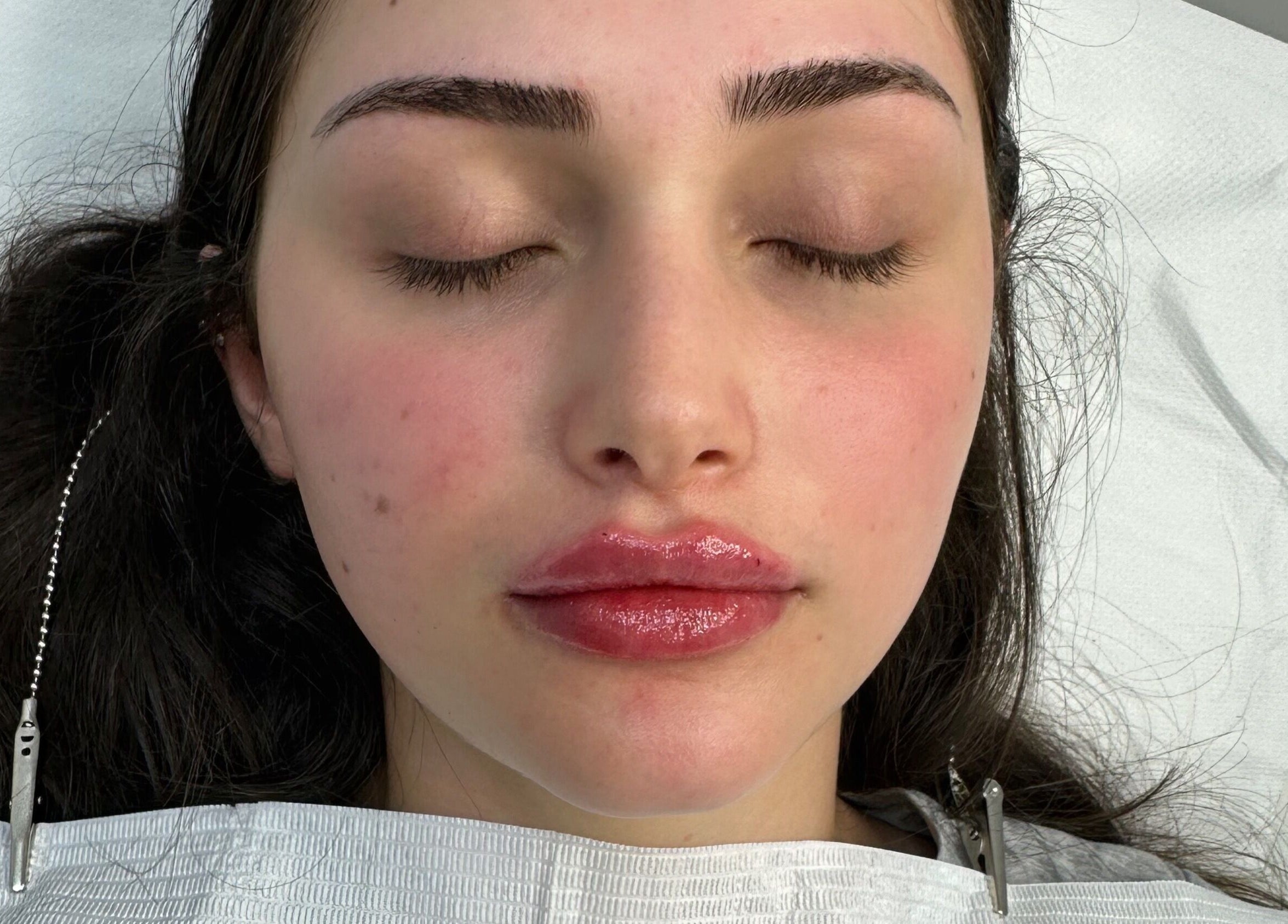 Relaxed client after lip treatment at Amavi Aesthetics, Kingston Upon Thames, England, GB.