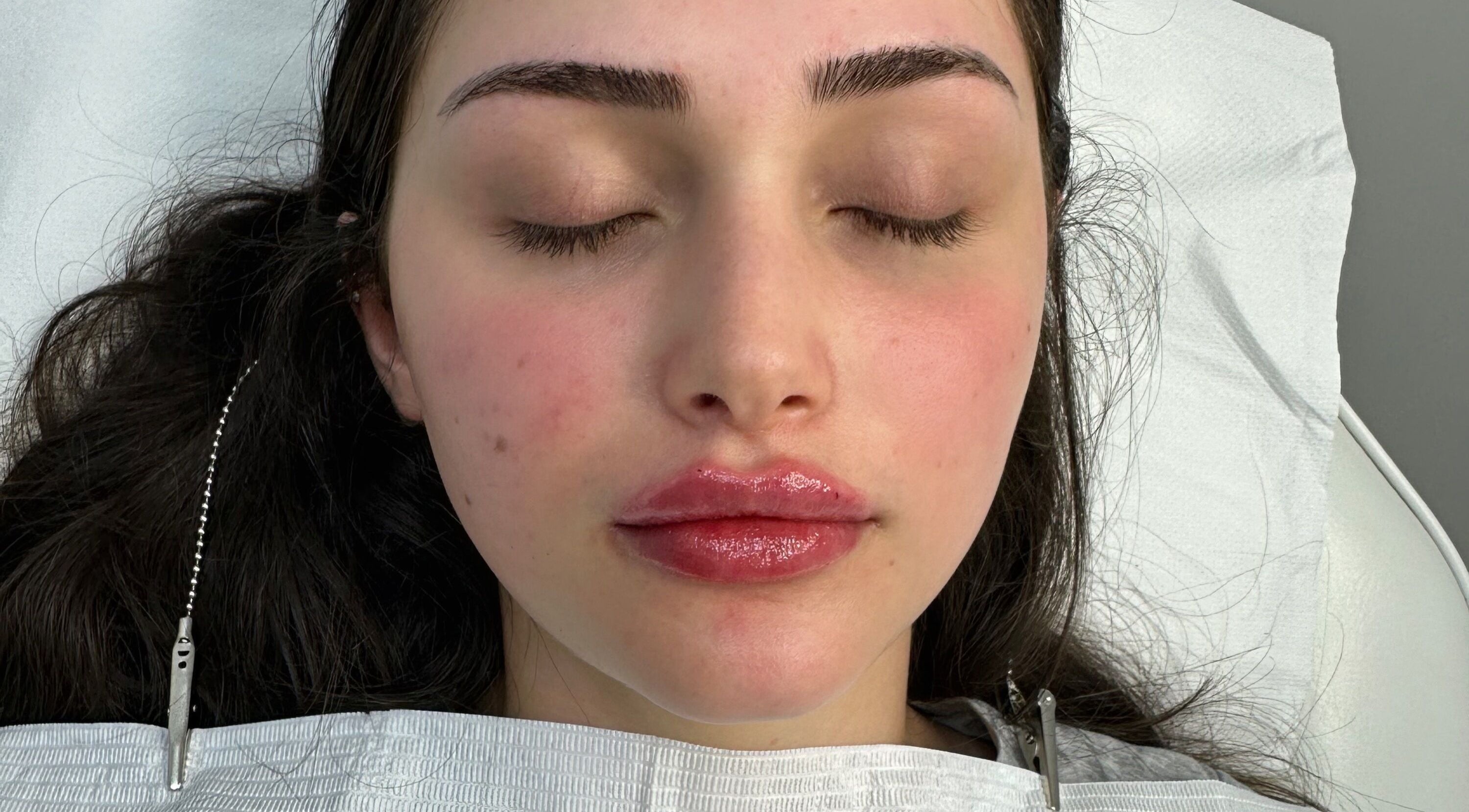 Relaxed client after lip treatment at Amavi Aesthetics, Kingston Upon Thames, England, GB.