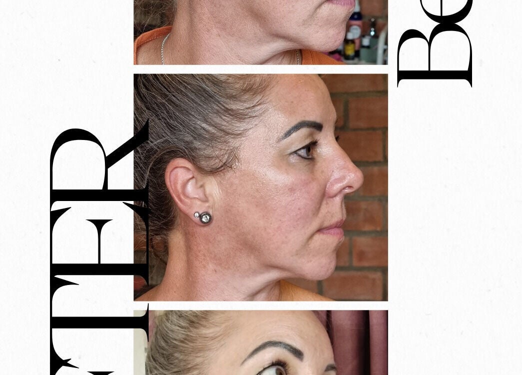 Before and after skin enhancement at Pretty Pamper, Jeffreys Bay, Eastern Cape, ZA.