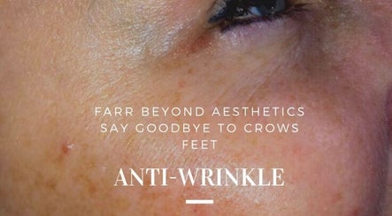 Farr Beyond Aesthetics in Plymouth, England offers effective anti-wrinkle treatments for smooth skin.