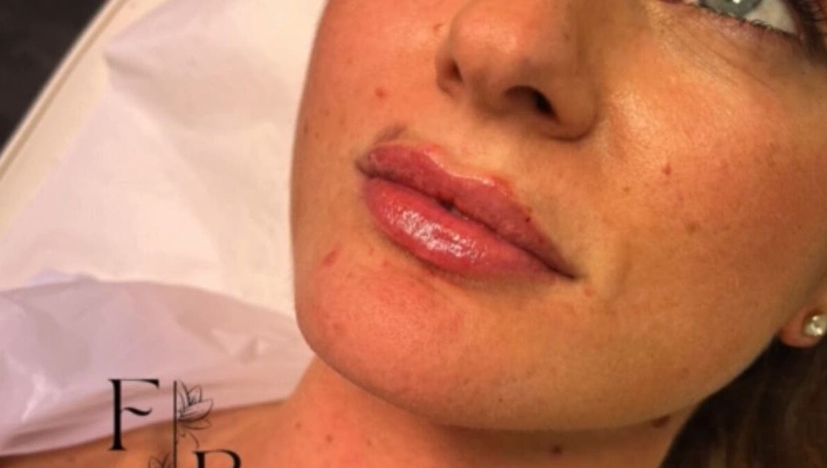 Close-up of post-treatment lips at Farr Beyond Aesthetics, Plymouth, England, GB.