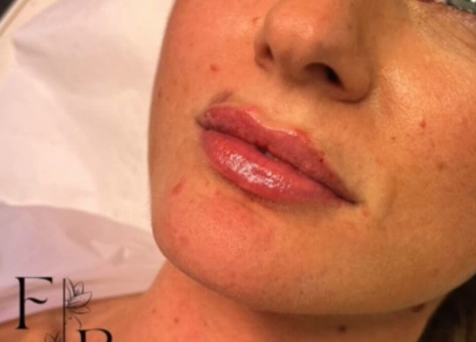 Close-up of post-treatment lips at Farr Beyond Aesthetics, Plymouth, England, GB.