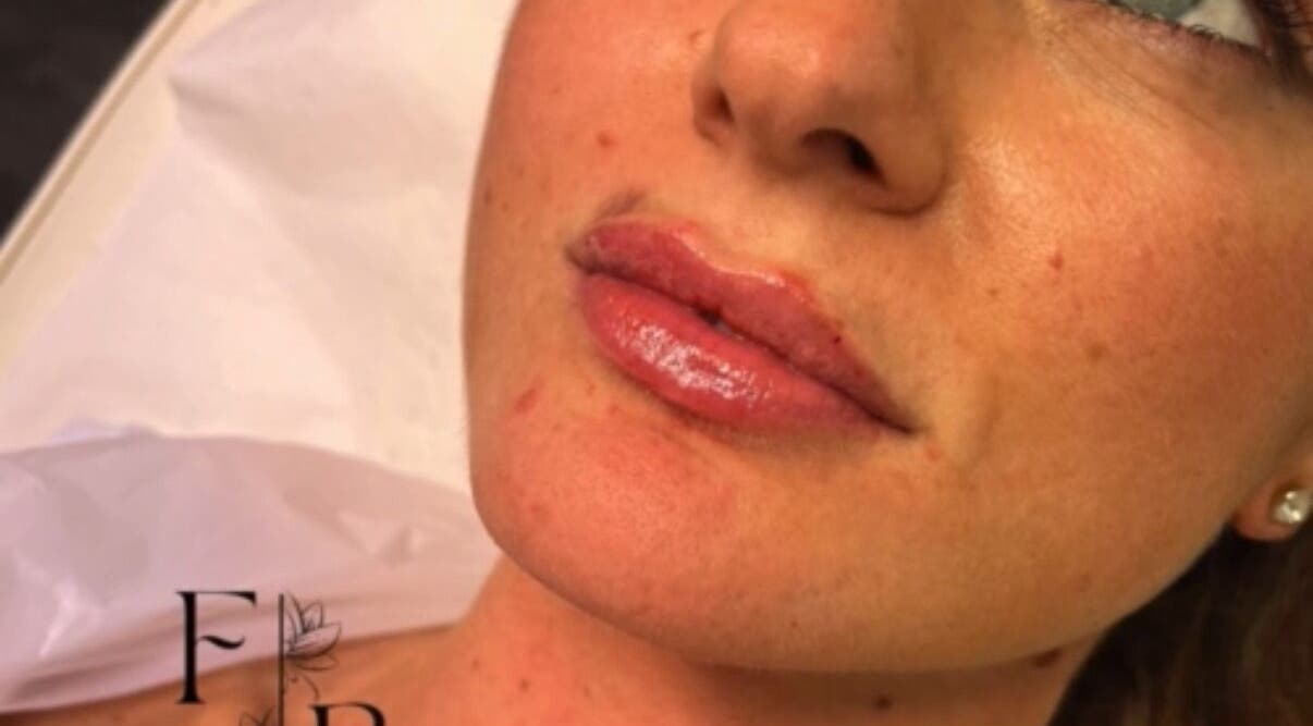 Close-up of post-treatment lips at Farr Beyond Aesthetics, Plymouth, England, GB.