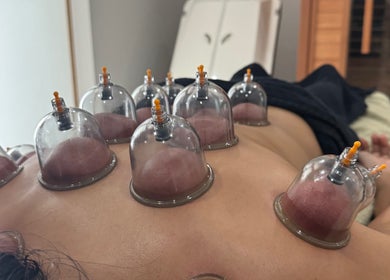 Cupping therapy at Mobile Treatments, Saint Michael, BB enhances wellness with rejuvenating effects.