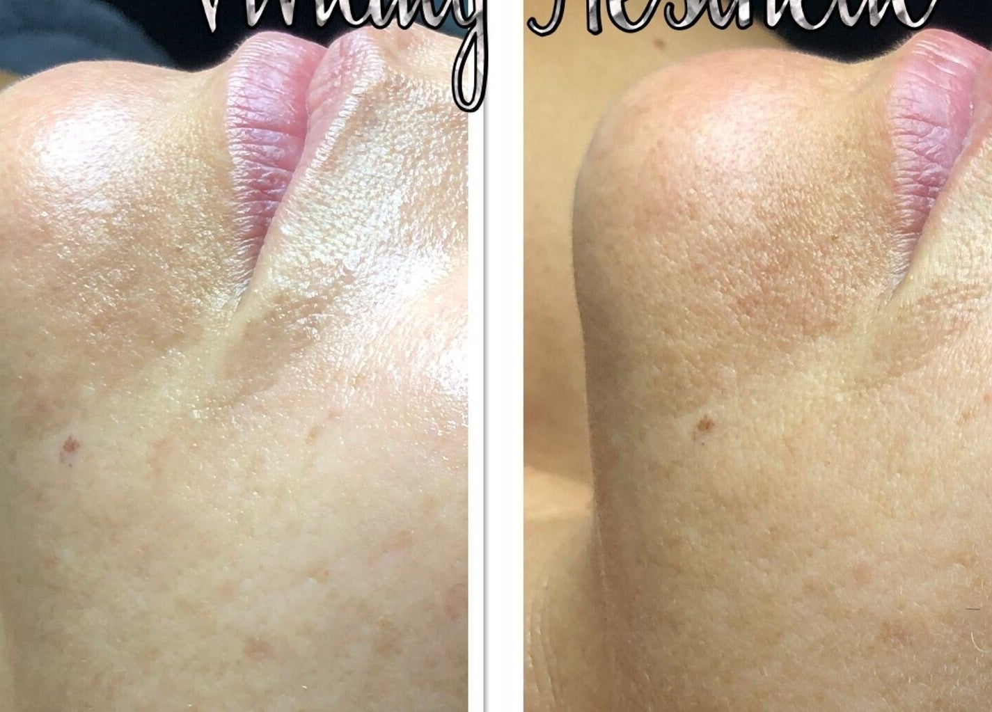 Before and after skin treatment at Vivu Lash & Skin, Tucson, Arizona, US showing significant improvement.