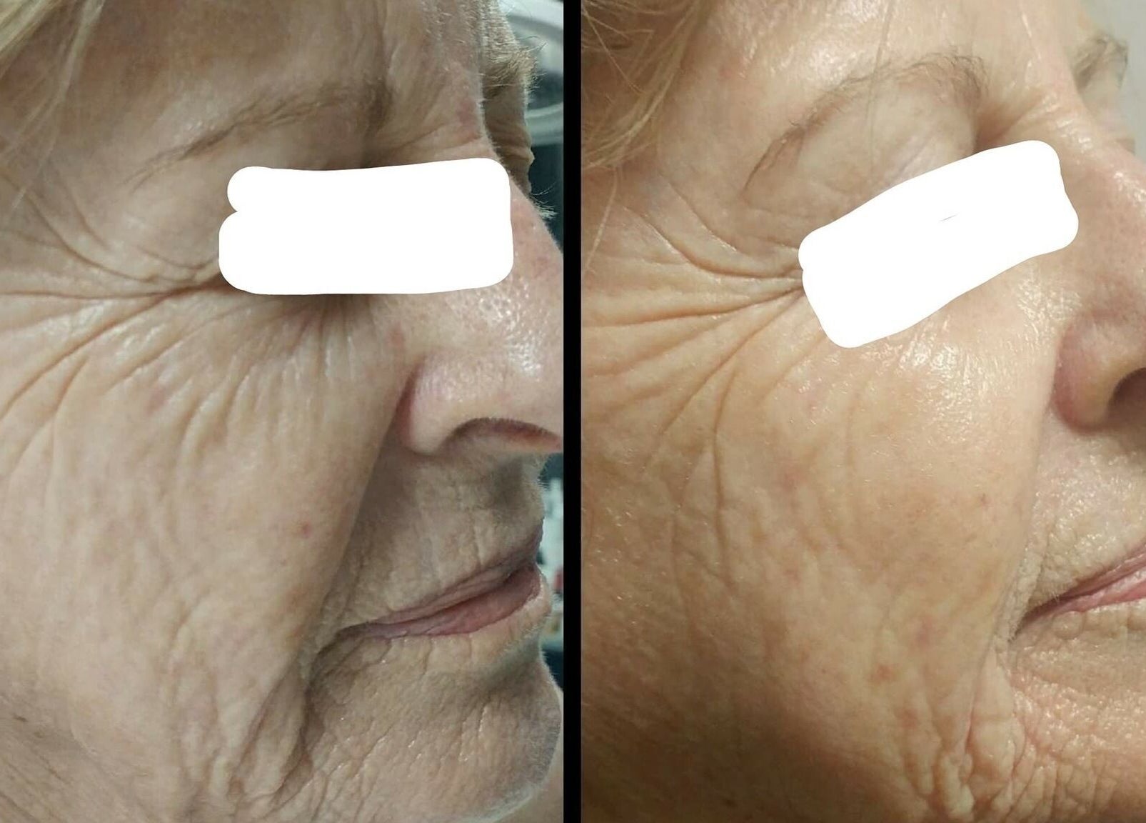 Before and after skin treatment at Vivu Lash & Skin, Tucson, Arizona, US. Visible improvement in texture.