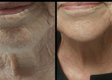 Before and after skin rejuvenation at Vivu Lash & Skin, Tucson, Arizona, US, showcasing reduced wrinkles.