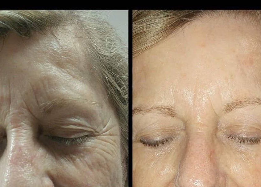 Before and after skin transformation at Vivu Lash & Skin, Tucson, Arizona, US showcasing reduced wrinkles.