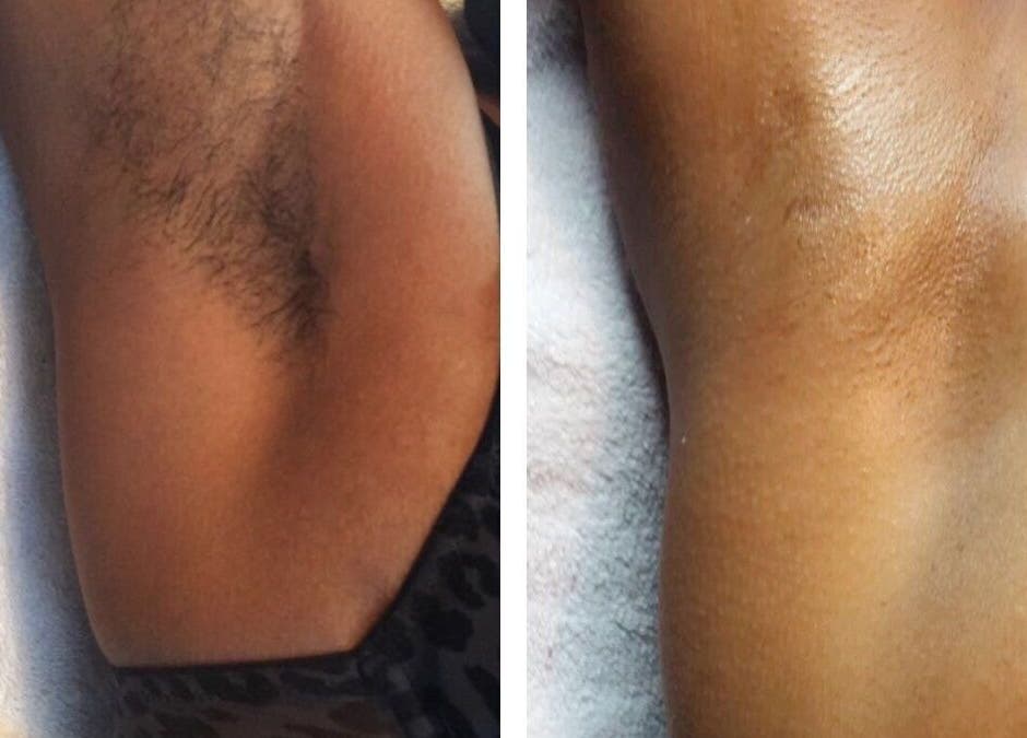 Underarm skin before and after waxing at The Self Farm Studio, Kingston, St. Andrew Parish, JM.