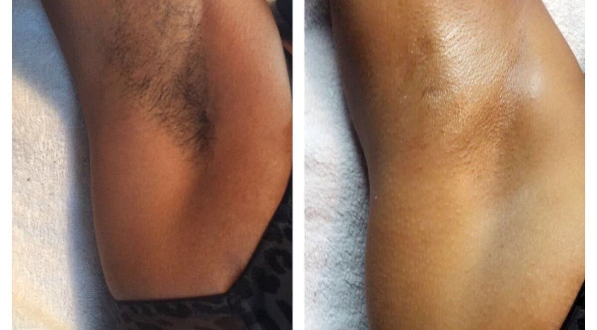 Underarm skin before and after waxing at The Self Farm Studio, Kingston, St. Andrew Parish, JM.
