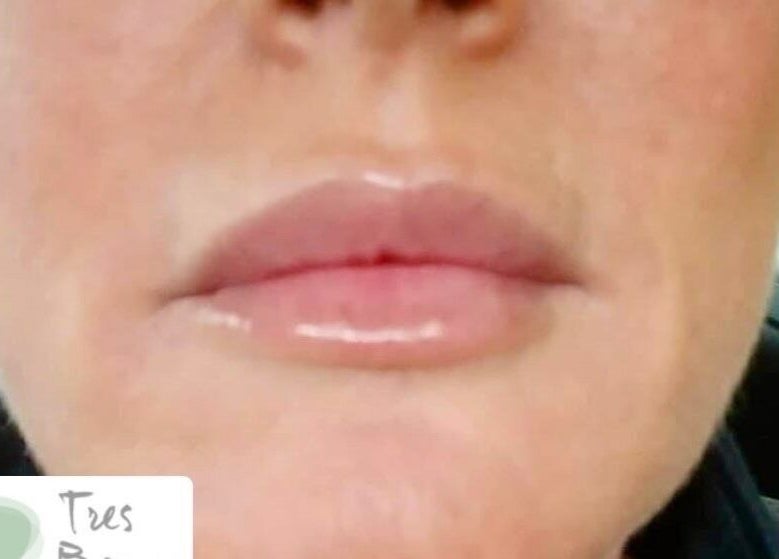 Glossy lips after treatment at Tres Beaux Aesthetics, Birmingham, England, GB. Showcasing smooth texture and shine.