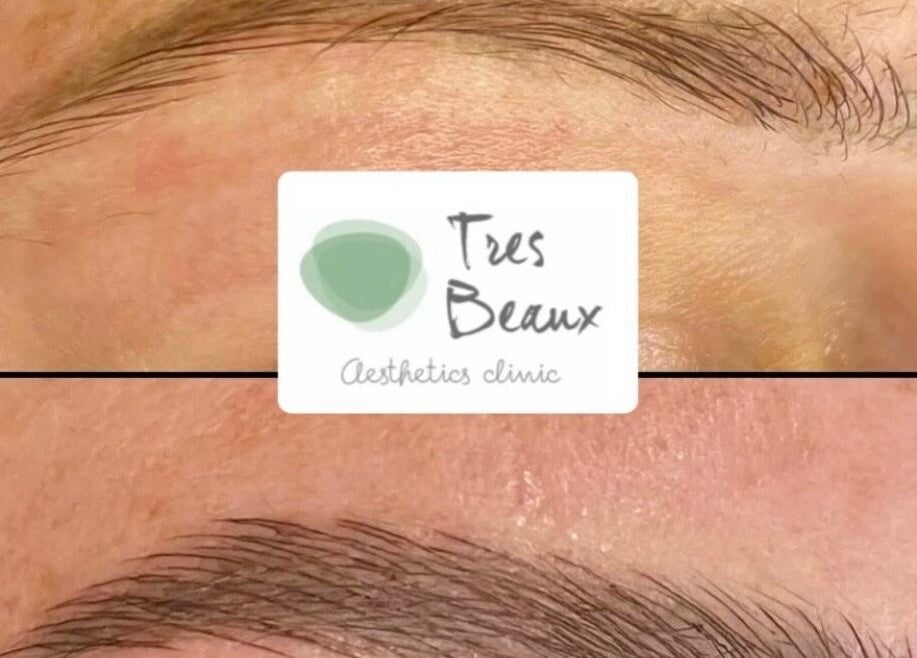 Eyebrow transformation before and after at Tres Beaux Aesthetics, Birmingham, England, GB.
