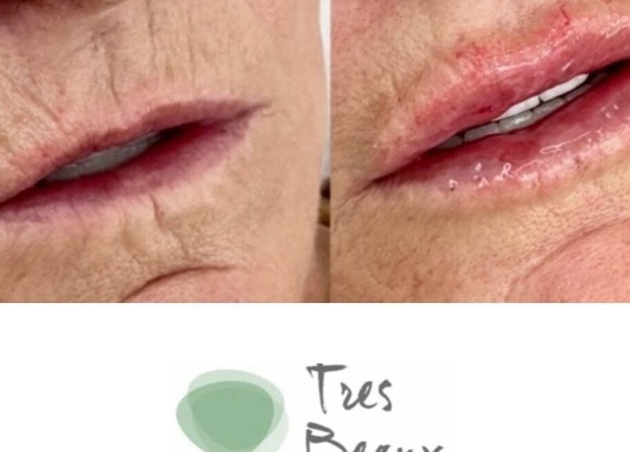 Before and after lip enhancement at Tres Beaux Aesthetics, Birmingham, England, GB.