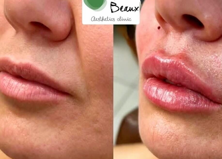 Before and after lip enhancement at Tres Beaux Aesthetics, Birmingham, England, GB.