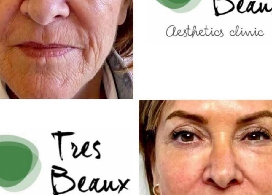 Transformation at Tres Beaux Aesthetics, Birmingham, England. Before and after facial rejuvenation results.