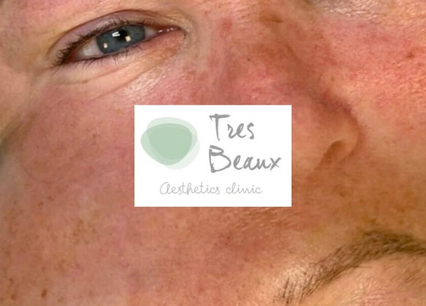 Close-up of rejuvenated skin at Tres Beaux Aesthetics, Birmingham, England, GB showcasing skincare results.