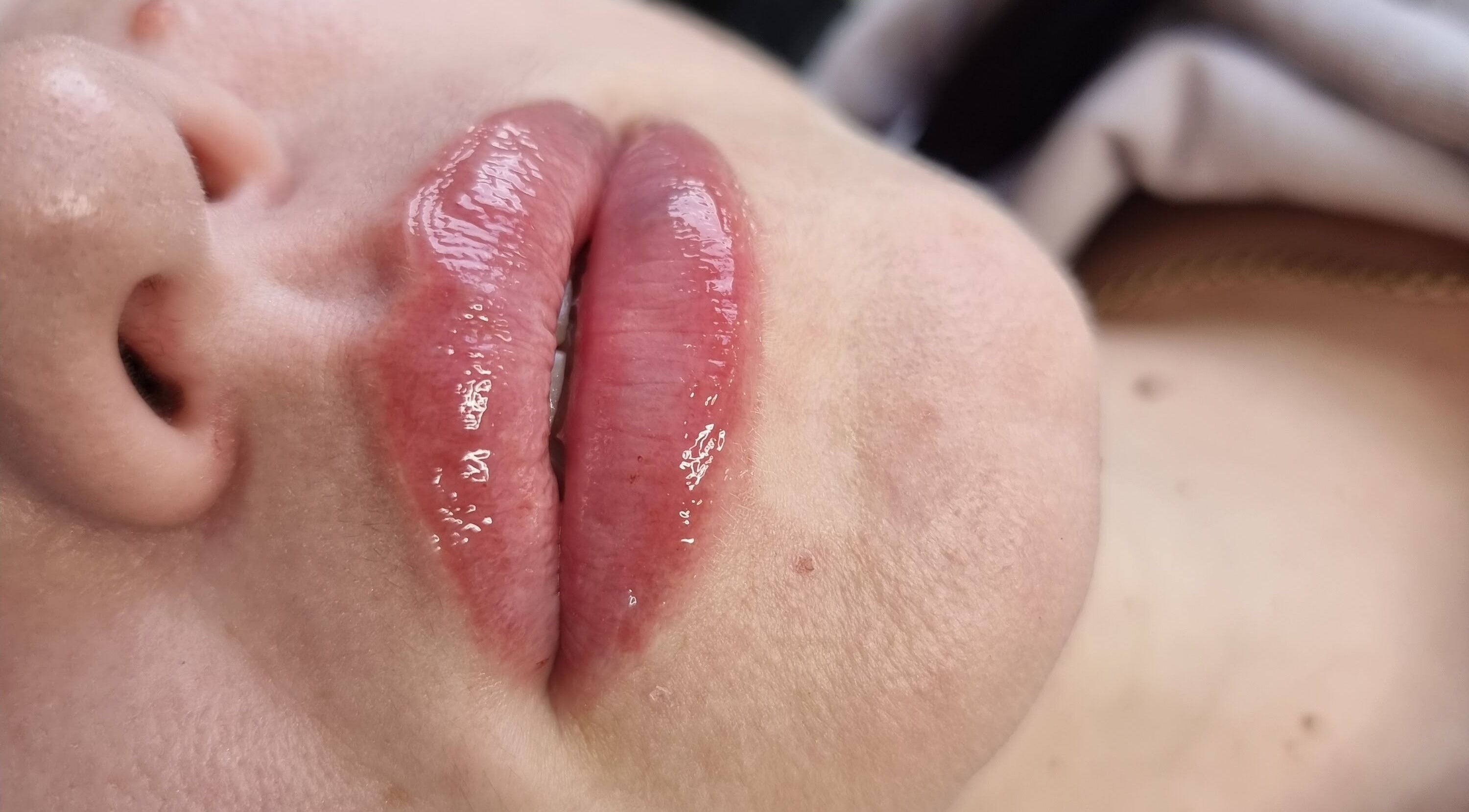 Glossy lip enhancement at Get a Beauty, Telford, England, GB. Perfectly sculpted and hydrated lips shown.