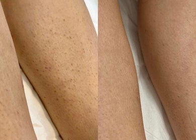 Smooth skin transformation at DCA Laser Hair Removal Clinic, Birmingham, England, GB. Effective treatment results.