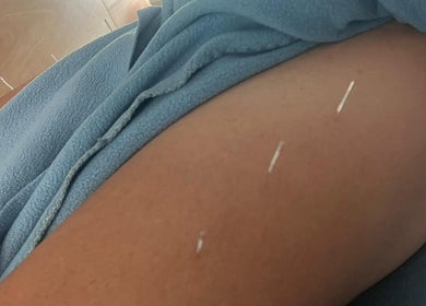 Therapeutic acupuncture session at Hoopnations (Mercury Baypark Arena), Mount Maunganui, Bay Of Plenty, NZ.